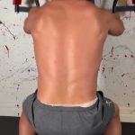 Surprise atomic wedgie